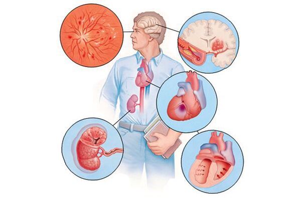 Poškodenie rôznych orgánov s predĺženou arteriálnou hypertenziou